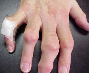 الأصابع التي تعاني من تشوهات في المفاصل تسبب الألم