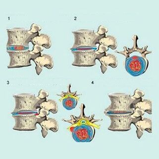 مراحل تطور تنخر العظم في عنق الرحم