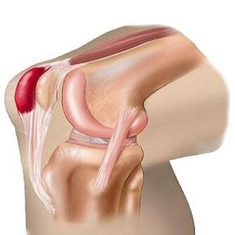 أحد أسباب الألم في مفصل الركبة هو التهاب الجراب. 