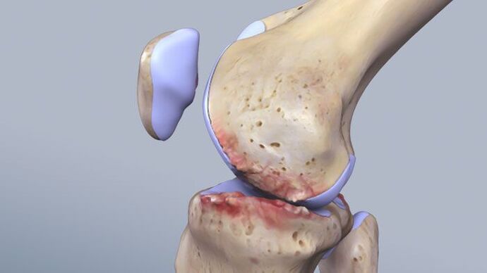 هيكل مفصل الركبة يتأثر بعلم الأمراض