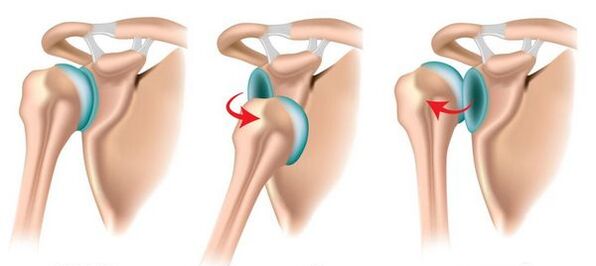 الخلع الأمامي والخلفي لمفصل الكتف، مما يثير تطور التهاب المفاصل