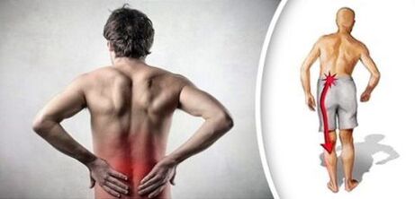 متلازمة الألم مع هشاشة العظم القطني يشع إلى الساقين
